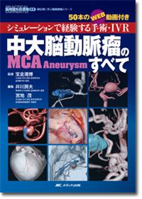 中大脳動脈瘤（MCA Aneurysm）のすべて
