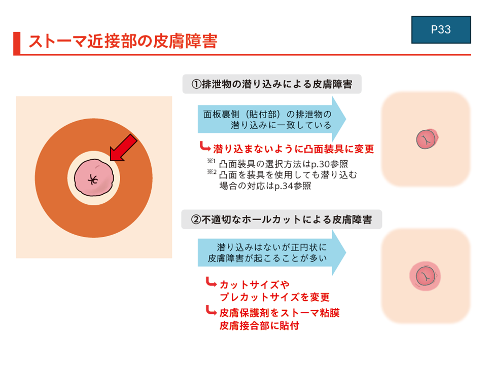 患者背景に沿ったストーマ装具の選びかた　【消化器ナーシング24年9号付】