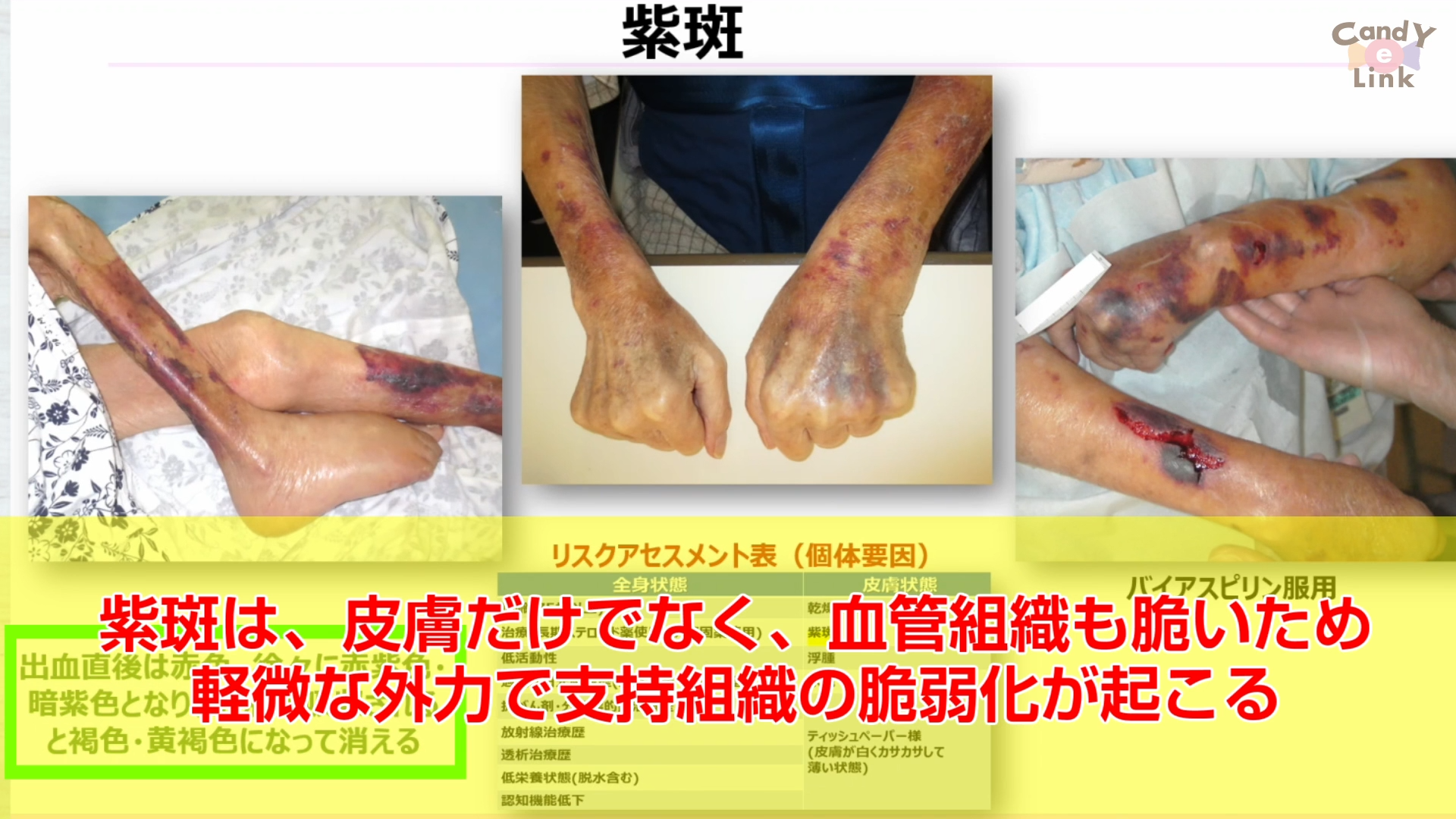 スキン-テアから高齢者を守る