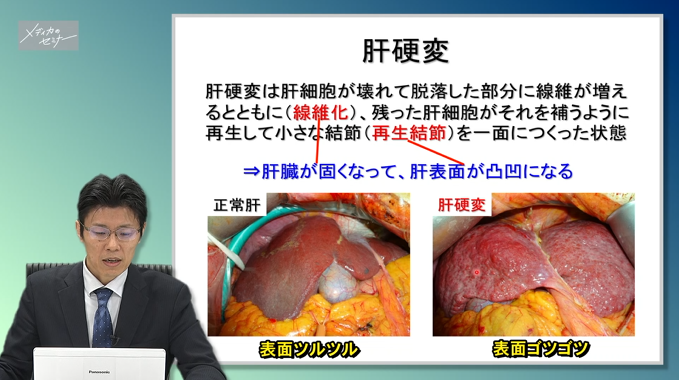 肝臓の解剖・疾患・治療の知識　【スライド資料ダウンロード】